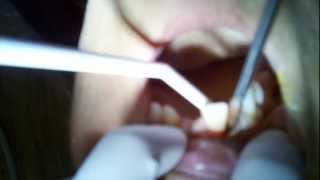 preview picture of video 'Dentist in Tigard, Oregon takes out my front tooth with his fingers.'