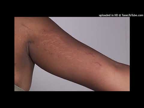 Uburyo bworoshye wakwikuraho amaribori burundu.