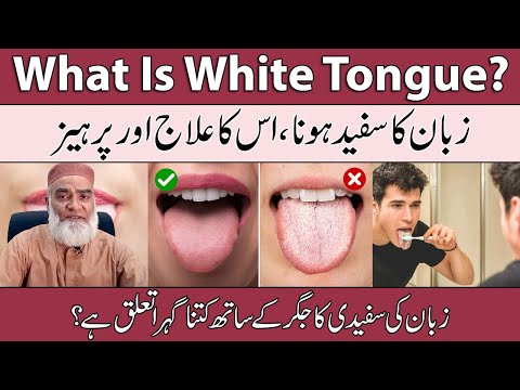 What Is White Tongue? | White Tongue Treatment | Zuban Ka Safed Hona Urdu | Al-Razaqi Health Recover