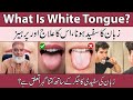 What Is White Tongue White Tongue Treatment Zuban Ka Safed Hona Urdu Al Razaqi Health Recover