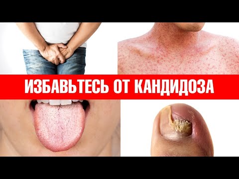 Примените эти 6 средств, и кандидоз никогда не вернется👍