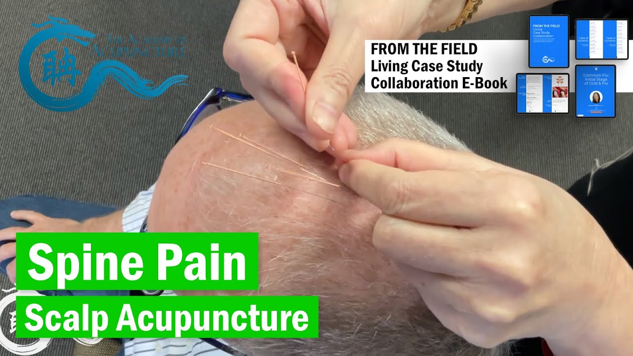 Thoracic Spine Pain treat w/Scalp #eileenhan #theacademyofacupuncture #韓玉齡 #balancemethodacupuncture