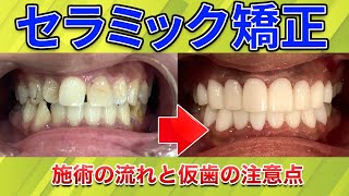 【セラミック矯正】短期間で歯並びが整う？施術期間やダウンタイムサムネイル