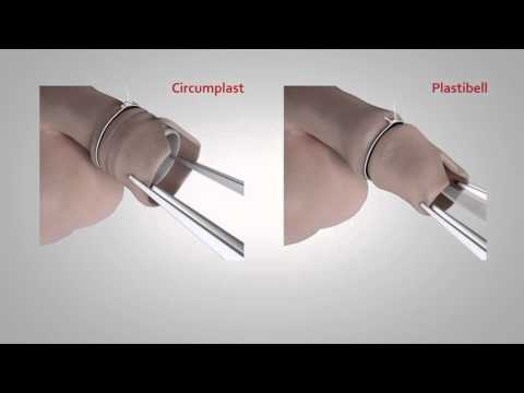 Circumplast vs Plastibell circumcision