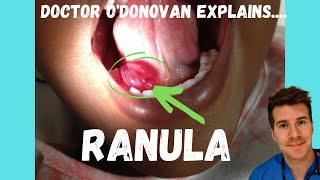 Explaining a Ranula or Mucocele | With Dr O