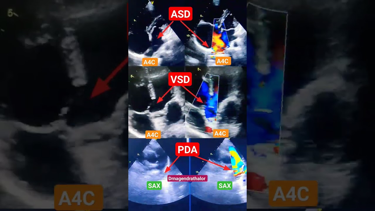 Hole in heart in one video l ASD, VSD, PDA l हार्ट मै होल l Echo #shorts