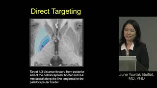 Deep brain stimulation for dystonia