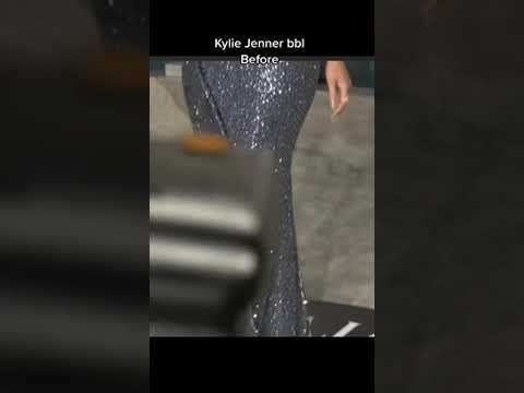 Kylie Jenner BBl Removal before and after