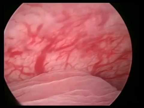 Art of hysteroscopy by osama shawki, polyp and CS scar