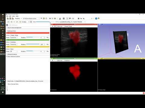 Real-time ultrasound AI segmentation and volume reconstruction