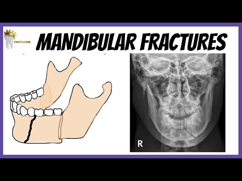 MANDIBULAR FRACTURES | Clinical features, radiographic diagnosis | Oral Surgery