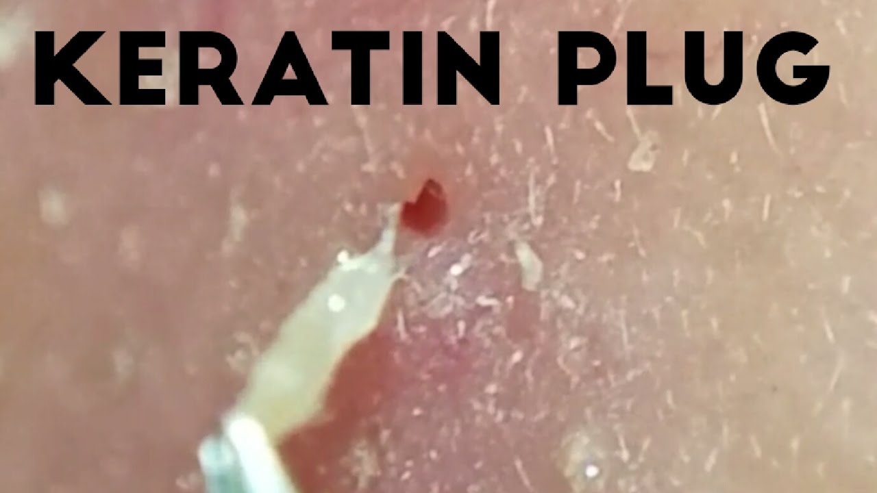 大きいやつやん！毛穴ぱっくり角栓連続ぬきI pulled out keratinplug.