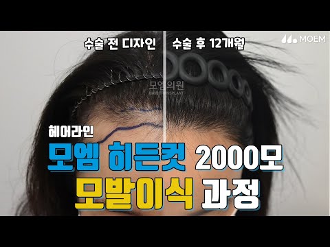 비절개 헤어라인교정 모발이식2000모 후기!｜전지훈 원장｜모엠의원(MOEM)