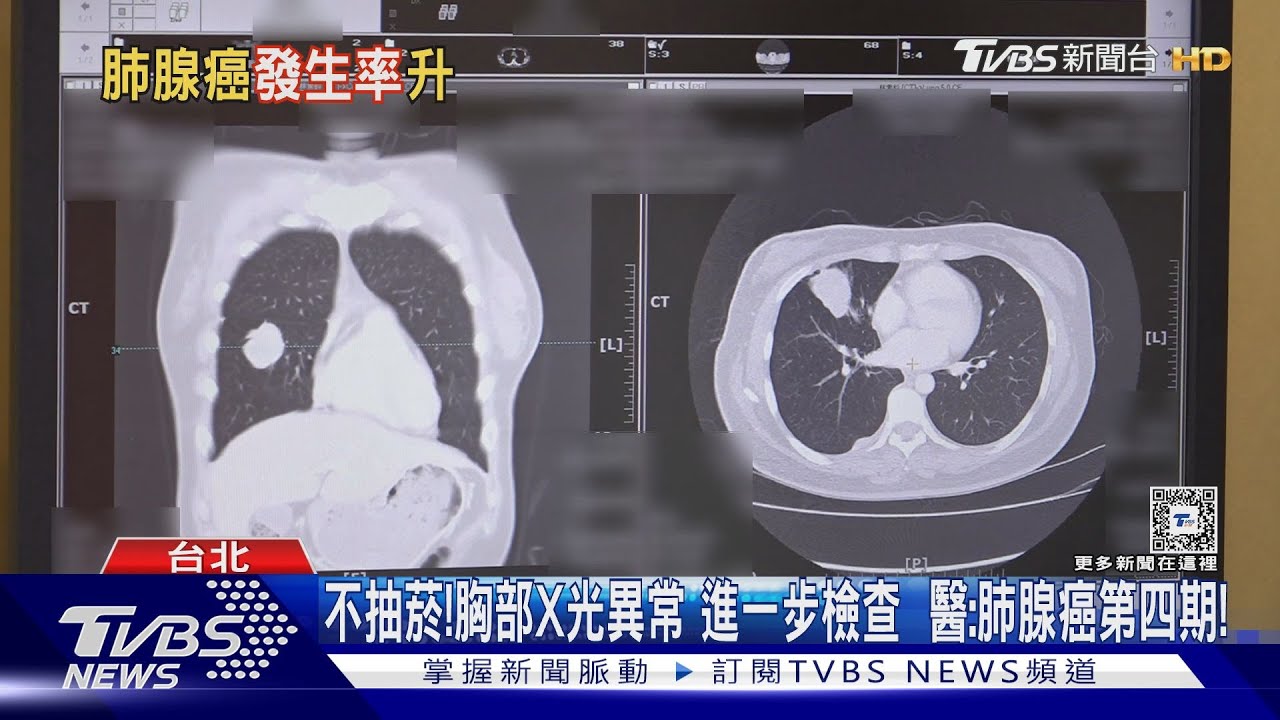 不吸菸...罹患肺腺癌第四期 醫警告:經常做「這件事」致死風險高!