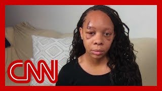 Woman shot in face by police with rubber bullet: I want to know why