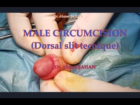 Circumcision (Dorsal slit tecnique), Erkek Çocuk Sünneti