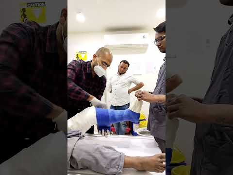टिबिया फ्रैक्चर के लिए घुटने के ऊपर फाइबरग्लास कास्ट कैसे लगाएँ? कास्ट के बारे में ज़रूरी जानकारी...
