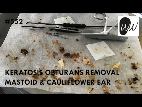 552 - Keratosis Obturans Removal from Mastoid & Cauliflower Ear