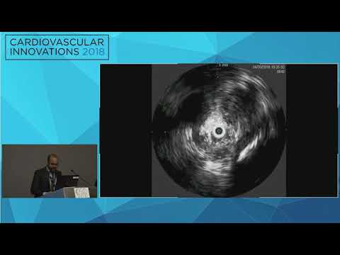 CVI2018 Session: Mechanical Thrombectomy and IVUS-guided Placement of Left Iliac Vein Stent