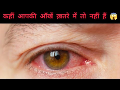 Red eye kyon hoti hai ! red eye ka ilaj #redeye #treatment @VisionandWellness