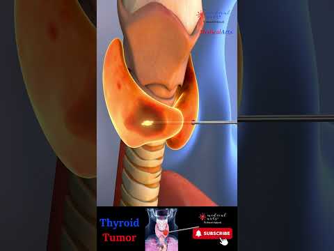 Goiter ※ Thyroid Tumor 💉Radiofrequency Ablation ┬┬ RFA
