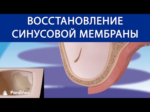 Восстановление синусовой мембраны ©