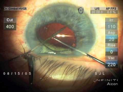 Repositionnement d'une lentille intraoculaire (LIO) disloquée.