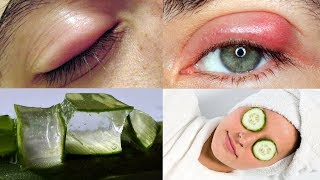 Effective Natural Home Remedies for Swollen Eyes | Home remedies Puffy eyes