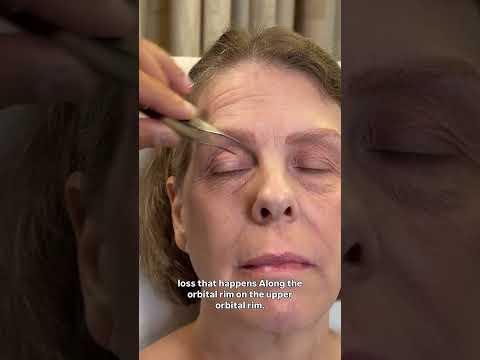 Pre-Op Plan for Tami, 55: Full Facelift Transformation
