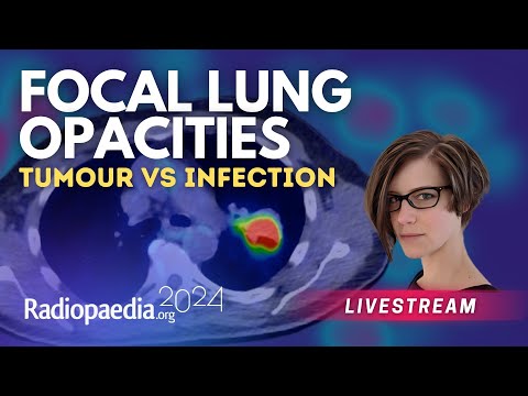 Focal lung opacities: tumour vs infection with​ Miranda Siemienowicz