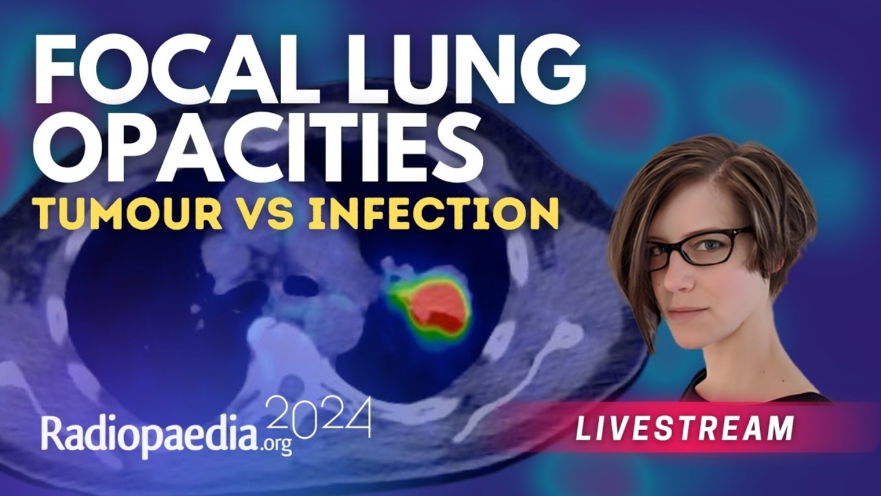 Focal lung opacities: tumour vs infection with​ Miranda Siemienowicz