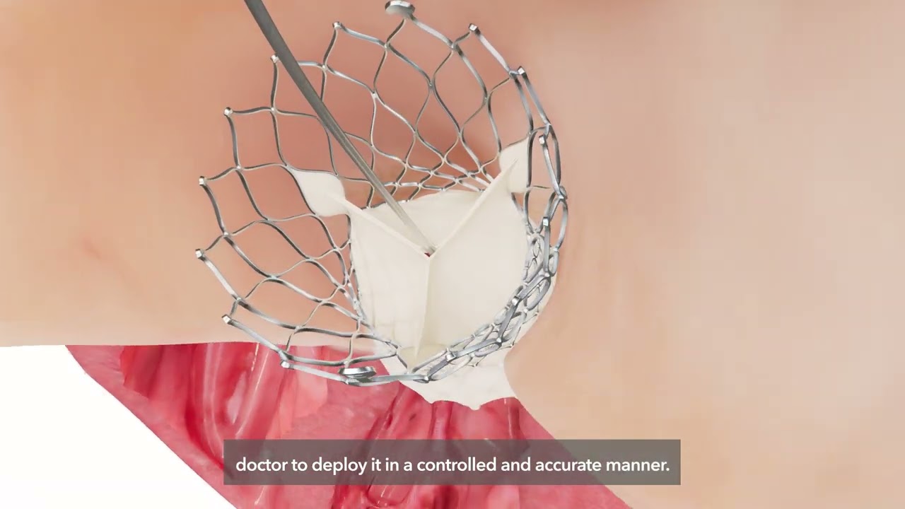 Animation showing heart valve replacement using the Medtronic TAVR system.