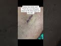 Keloid Scar Removal Shorts