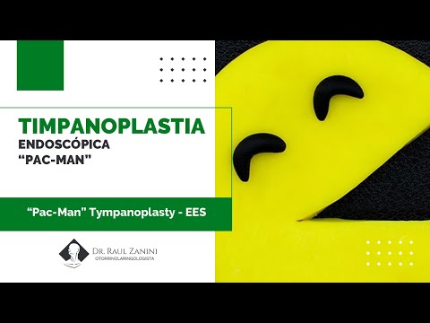 Miniatura: Timpanoplastia Underlay com Fáscia e Cartilagem