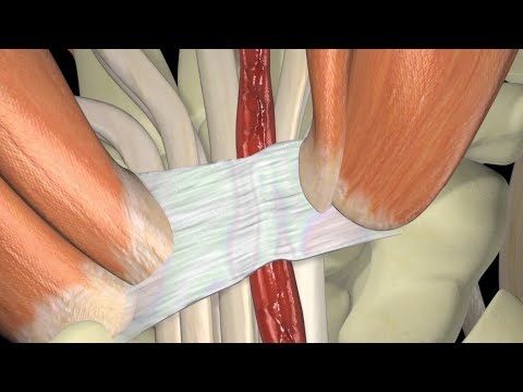 Síndrome del túnel carpiano