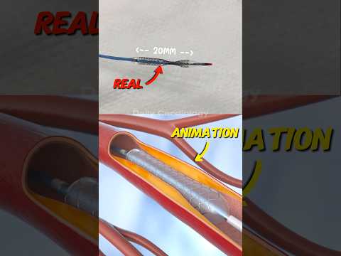 Real vs Animation: How a Stent is Placed in Angioplasty | Heart Procedure Explained #Shorts