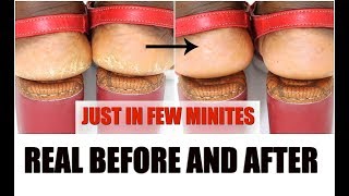 How To Get Rid Of Dry Cracked Heels Fast For Smooth And Soft Feet In Minutes