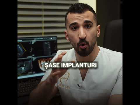 Câte implanturi sunt necesare?