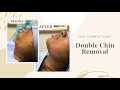 Double Chin Removal By Dr Nadir Qazi