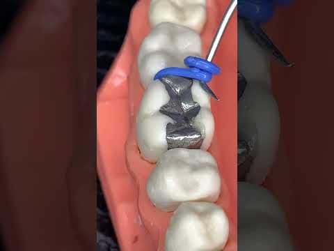 🔥DENTAL SPACERS🔥