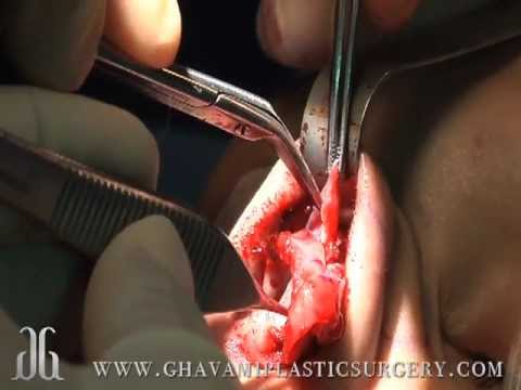 Dramatic Nose Job-In the Operating Room and Before Afters with Dr. Ghavami