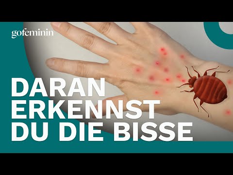 Bettwanzen? Daran erkennst du die Bisse