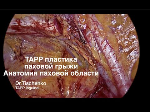 TAPP пластика паховой грыжи+анатомия.