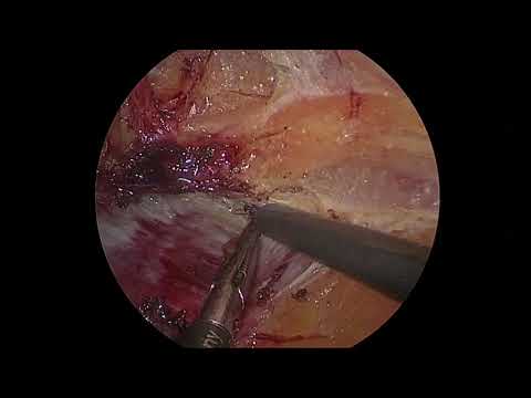 Understanding the Anatomy of Subxiphoid Dissection in TAR