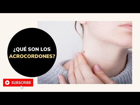 ¿ACROCORDONES? MIRA ESTE VÍDEO