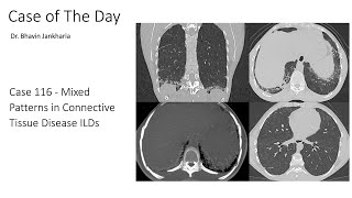 Case of the Day - 116 - 2025 10 09 - Mixed Patterns in Connective Tissue Disease ILDs