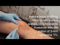 Injection Technique Into The Knee Joint For OA