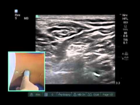 How To: Ultrasound-Guided Popliteal Sciatic Nerve Block Scanning Technique Video