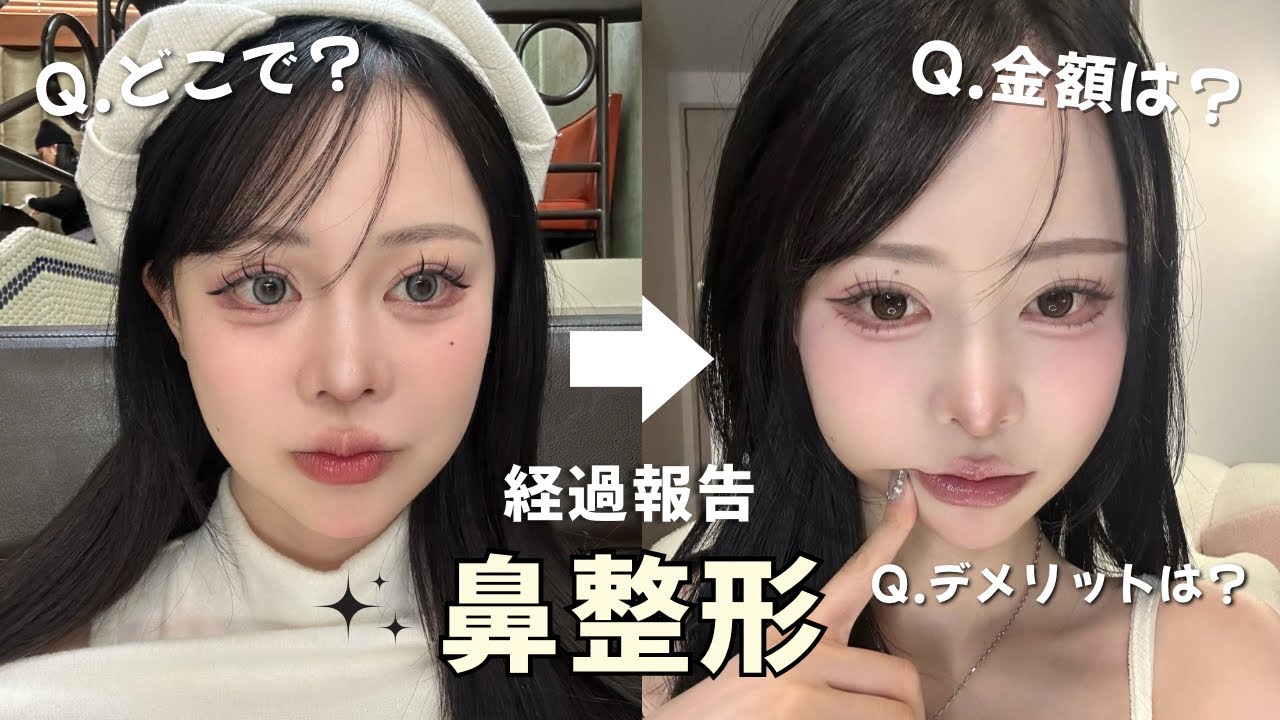 【鼻整形】ダウンタイムと経過報告！5ヶ月目🪄