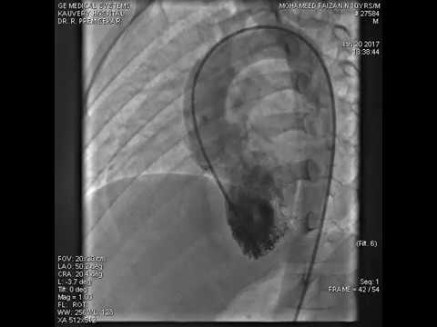 Antegrade route perimembranous VSD device closure without forming an arteriovenous (AV) loop